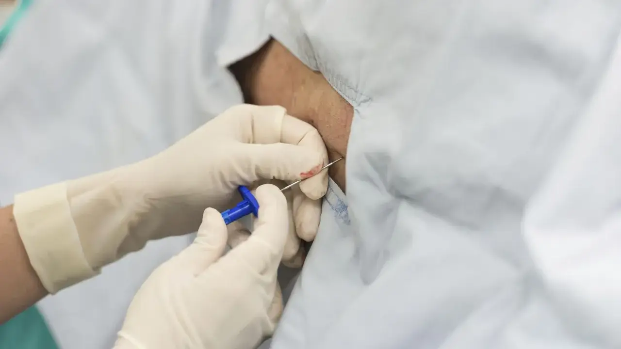 Rękawiczki medyczne zakładane są do podania znieczulenia epiduralnego.