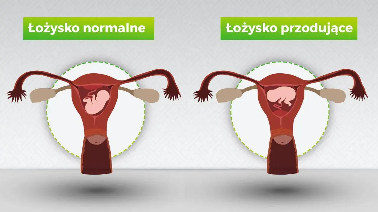 Porównanie: łożysko normalne vs. łożysko przodujące. Na pierwszym obrazku łożysko znajduje się na tylnej ścianie macicy, a na drugim – łożysko na przedniej ścianie.
