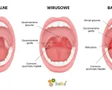 Porównanie gardła: normalne, wirusowe i bakteryjne. Obraz pokazuje objawy, które pomagają określić, ile trwa angina.