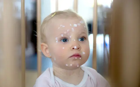 Małe dziecko z niebieskimi oczami i blond włosami ma na twarzy i szyi kropki, które świadczą o ospie u dzieci.