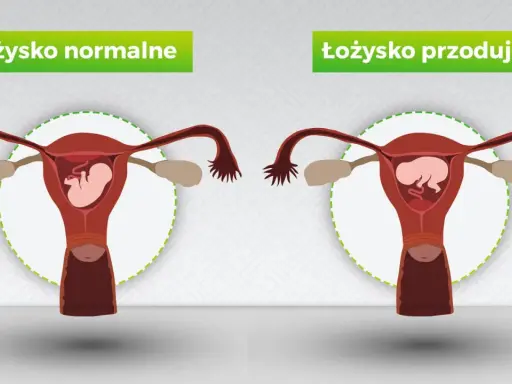 Porównanie: łożysko normalne vs. łożysko przodujące. Na pierwszym obrazku łożysko znajduje się na tylnej ścianie macicy, a na drugim – łożysko na przedniej ścianie.