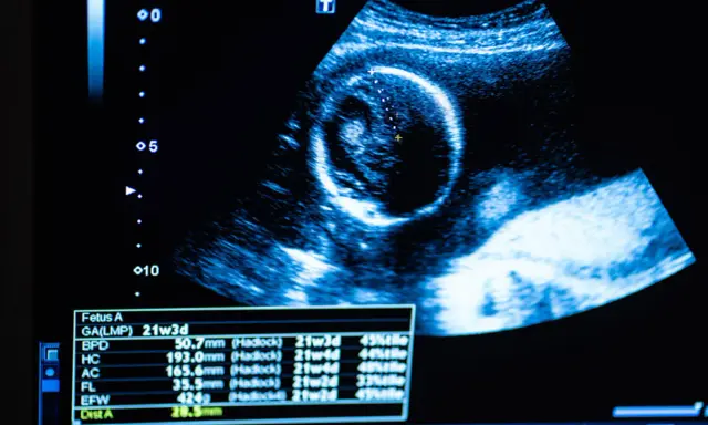 Obraz usg ciąży pokazuje rozwijający się płód. Na ekranie widoczne są pomiary i wiek ciąży.