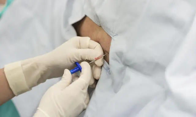 Rękawiczki medyczne zakładane są do podania znieczulenia epiduralnego.