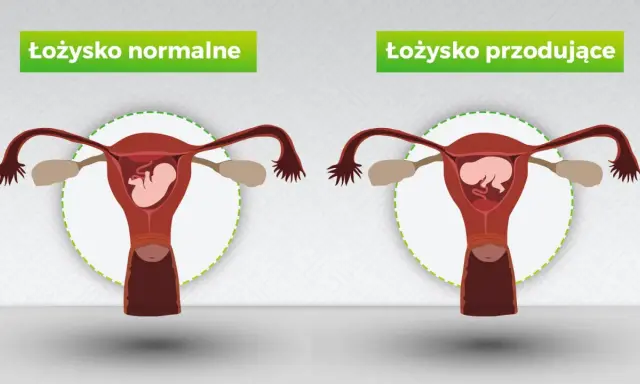Porównanie: łożysko normalne vs. łożysko przodujące. Na pierwszym obrazku łożysko znajduje się na tylnej ścianie macicy, a na drugim – łożysko na przedniej ścianie.