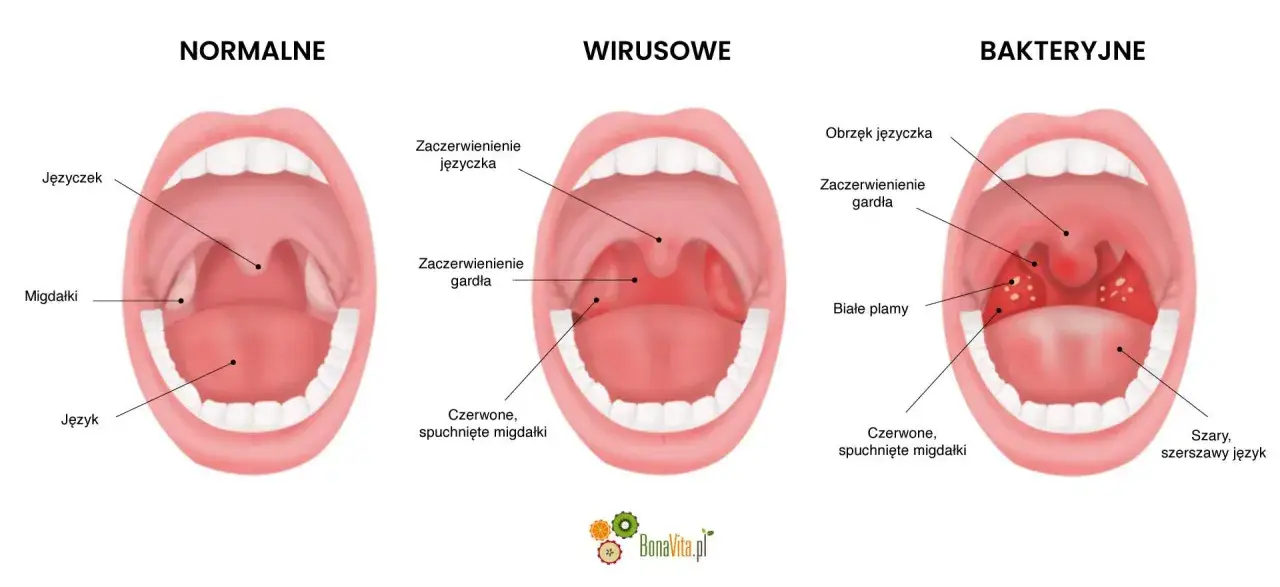 Porównanie gardła: normalne, wirusowe i bakteryjne. Obraz pokazuje objawy, które pomagają określić, ile trwa angina.