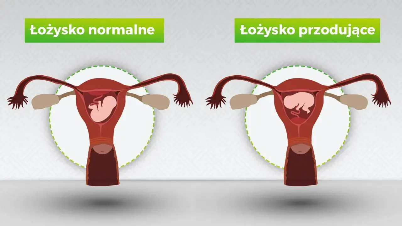 Porównanie: łożysko normalne vs łożysko przodujące. Na pierwszym obrazku łożysko znajduje się na tylnej ścianie macicy, a na drugim - łożysko przodujące na przedniej ścianie.